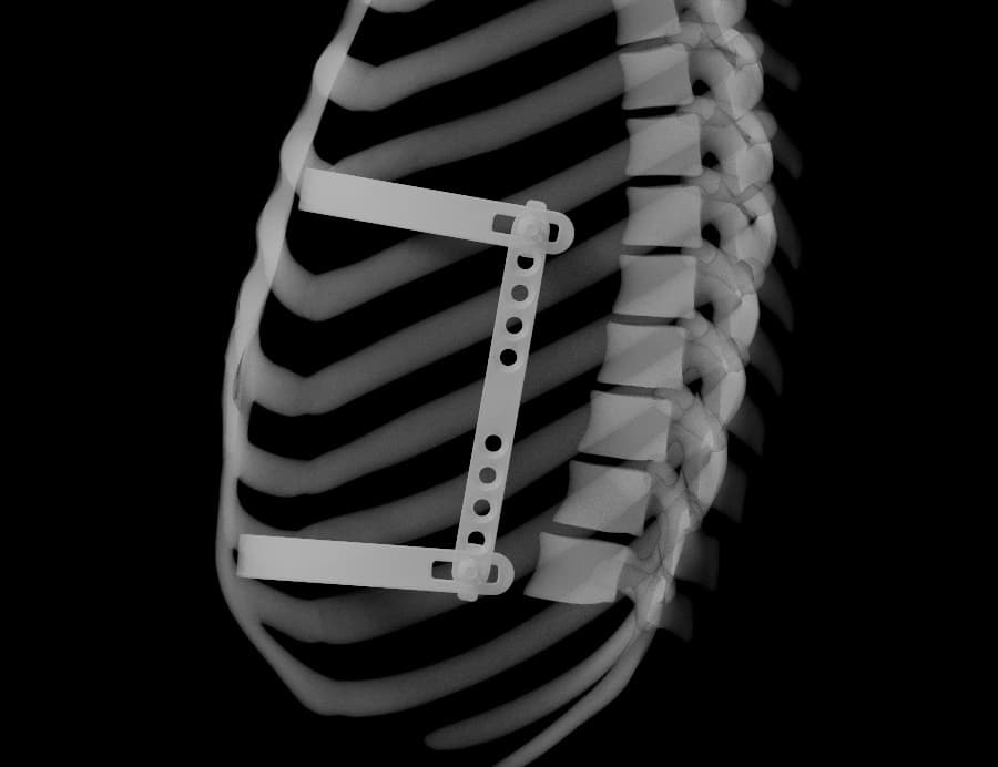 Lateral chest X-ray showing the upper and lower bars of the Bridge Fixator