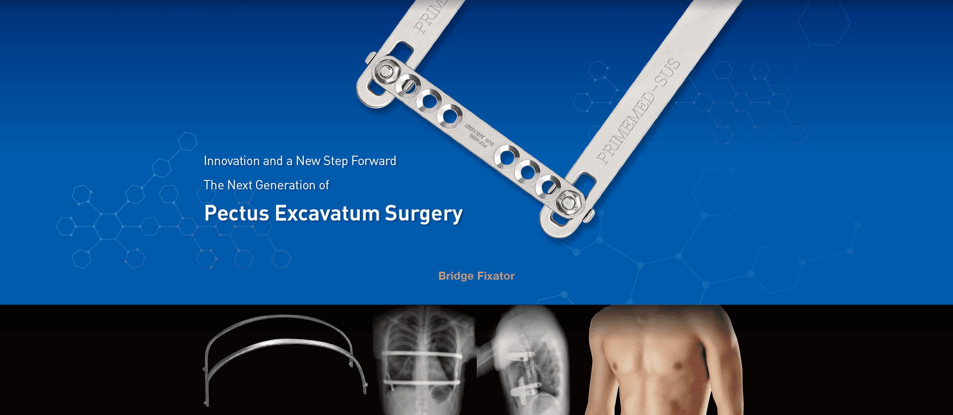 Bridge Fixator: the next generation of pectus excavatum surgery