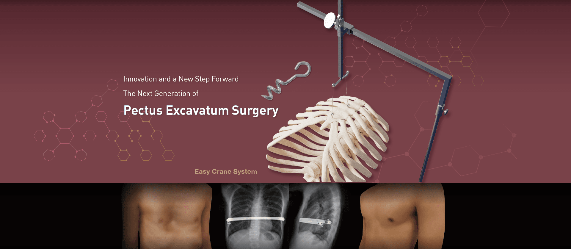 Single Bar Technique: the next generation of pectus excavatum surgery