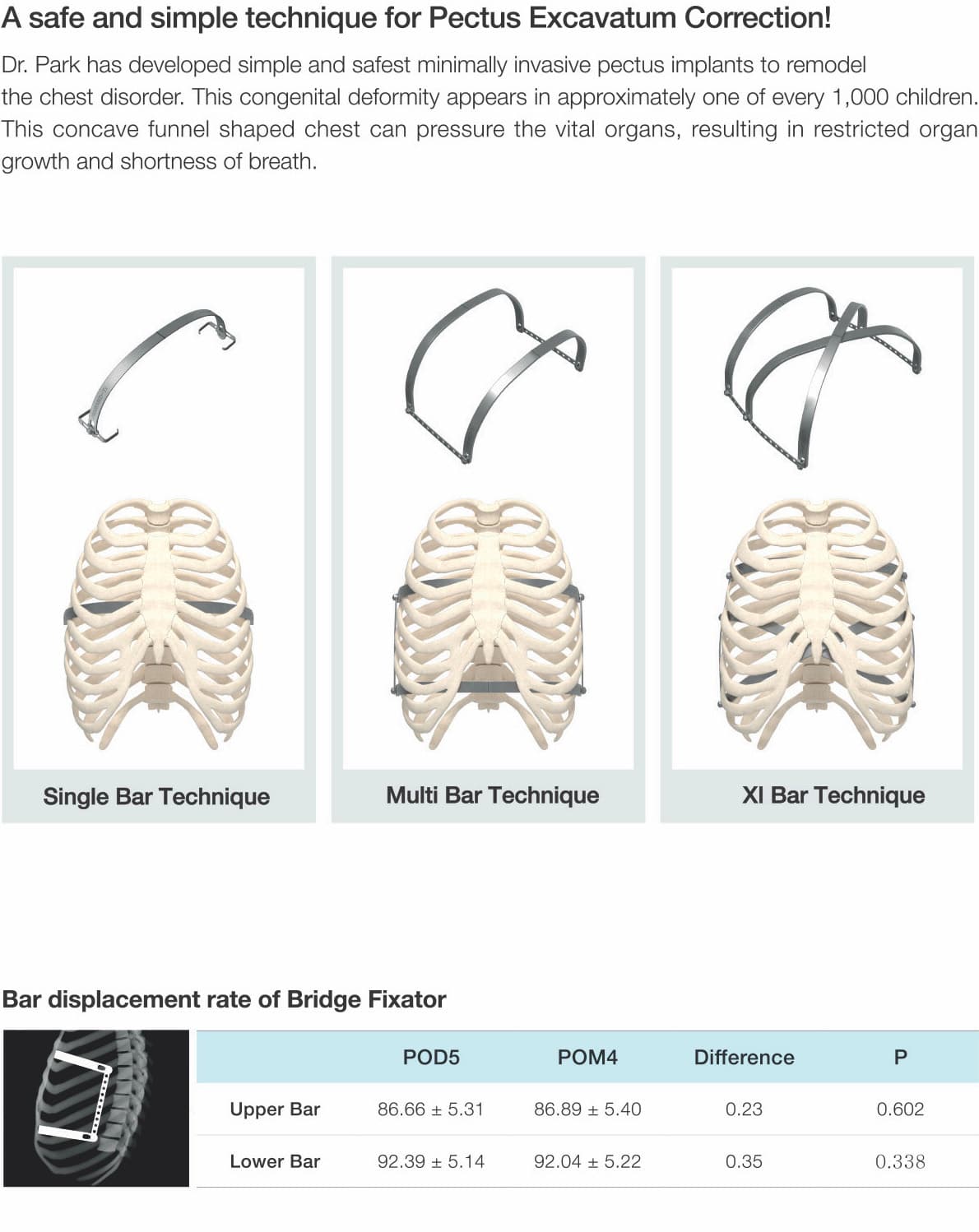 Park's Pectus System overview (2/7)