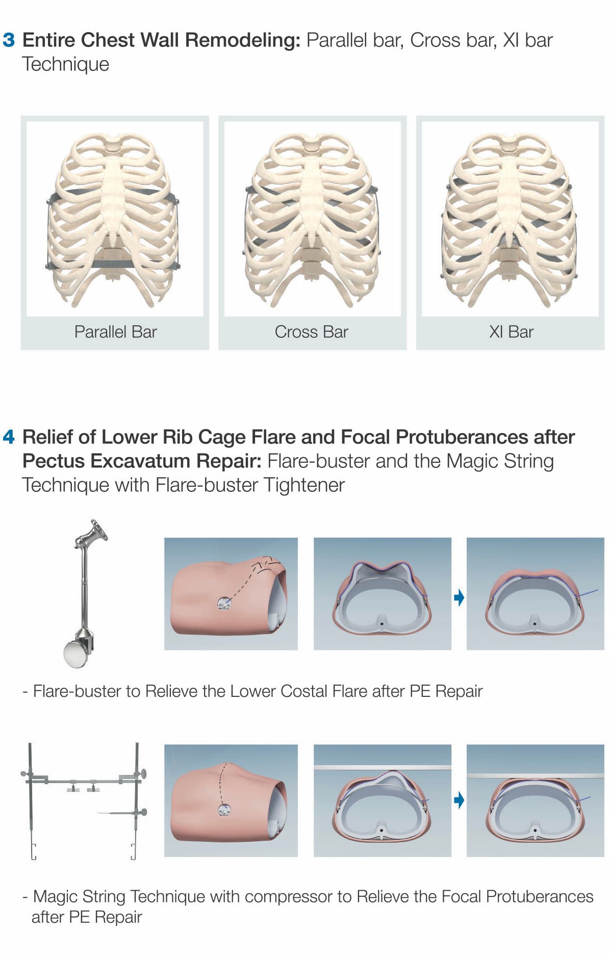 Park's Pectus System overview (6/7)