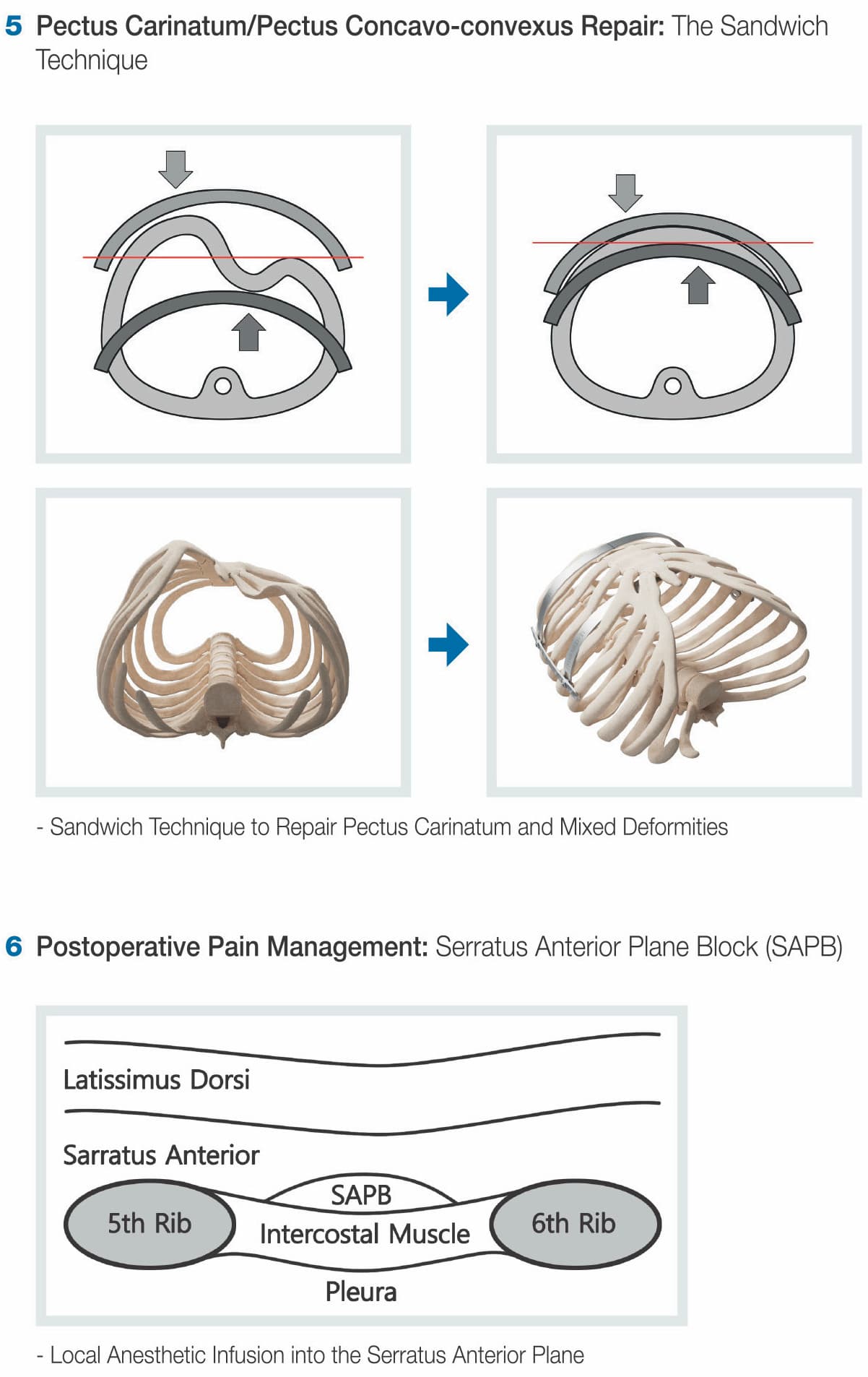 Park's Pectus System overview (7/7)