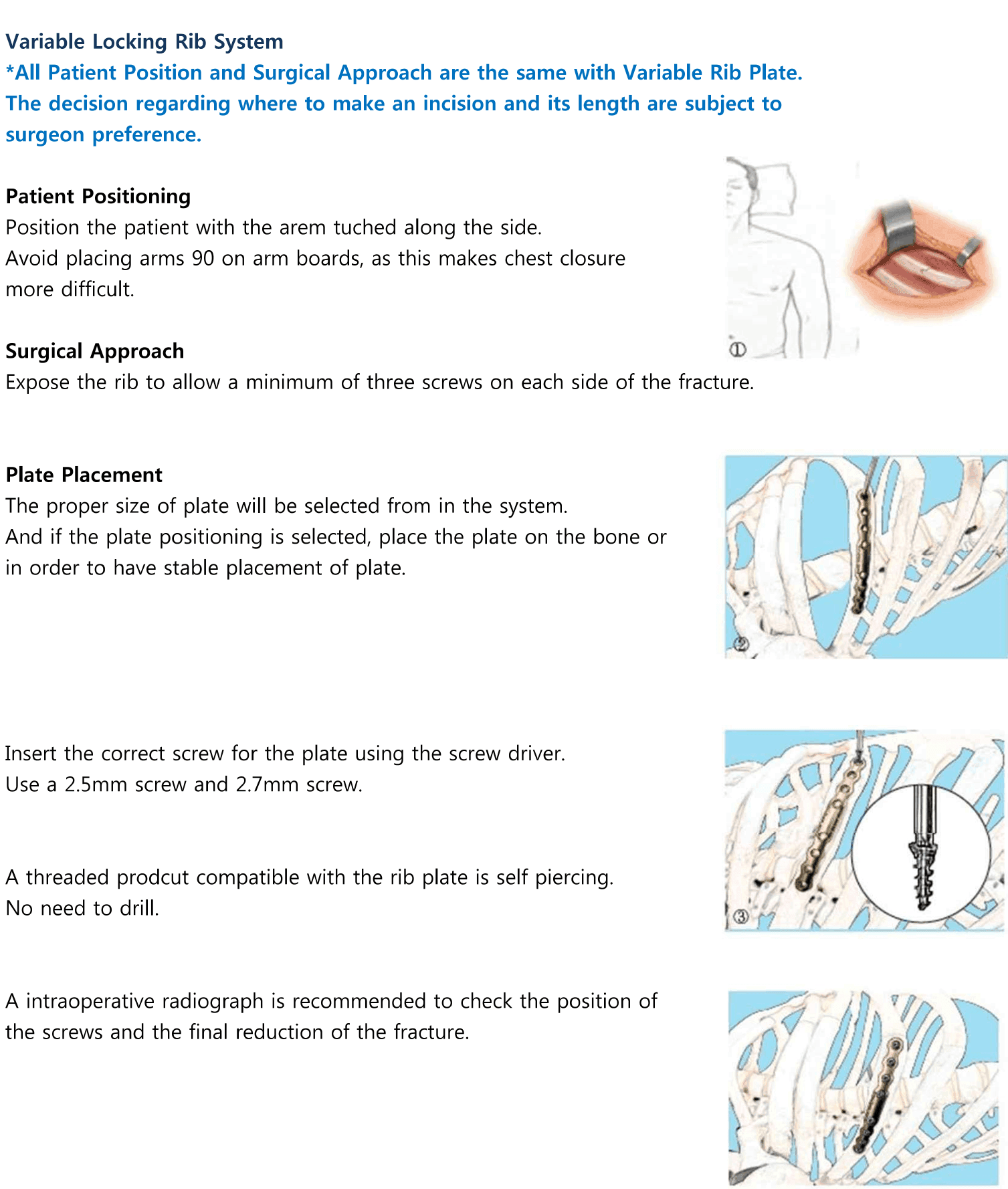 Prime Rib System surgical technique